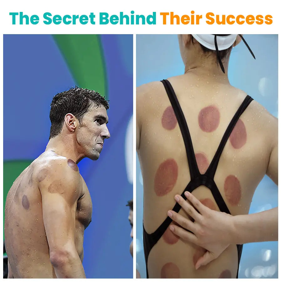 Swimmer Michael Phelps and a female athlete with round cupping marks on their backs, illustrating the effectiveness of cupping therapy for muscle recovery in athletes.